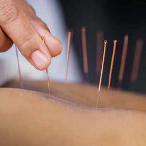 Akupuntur massage